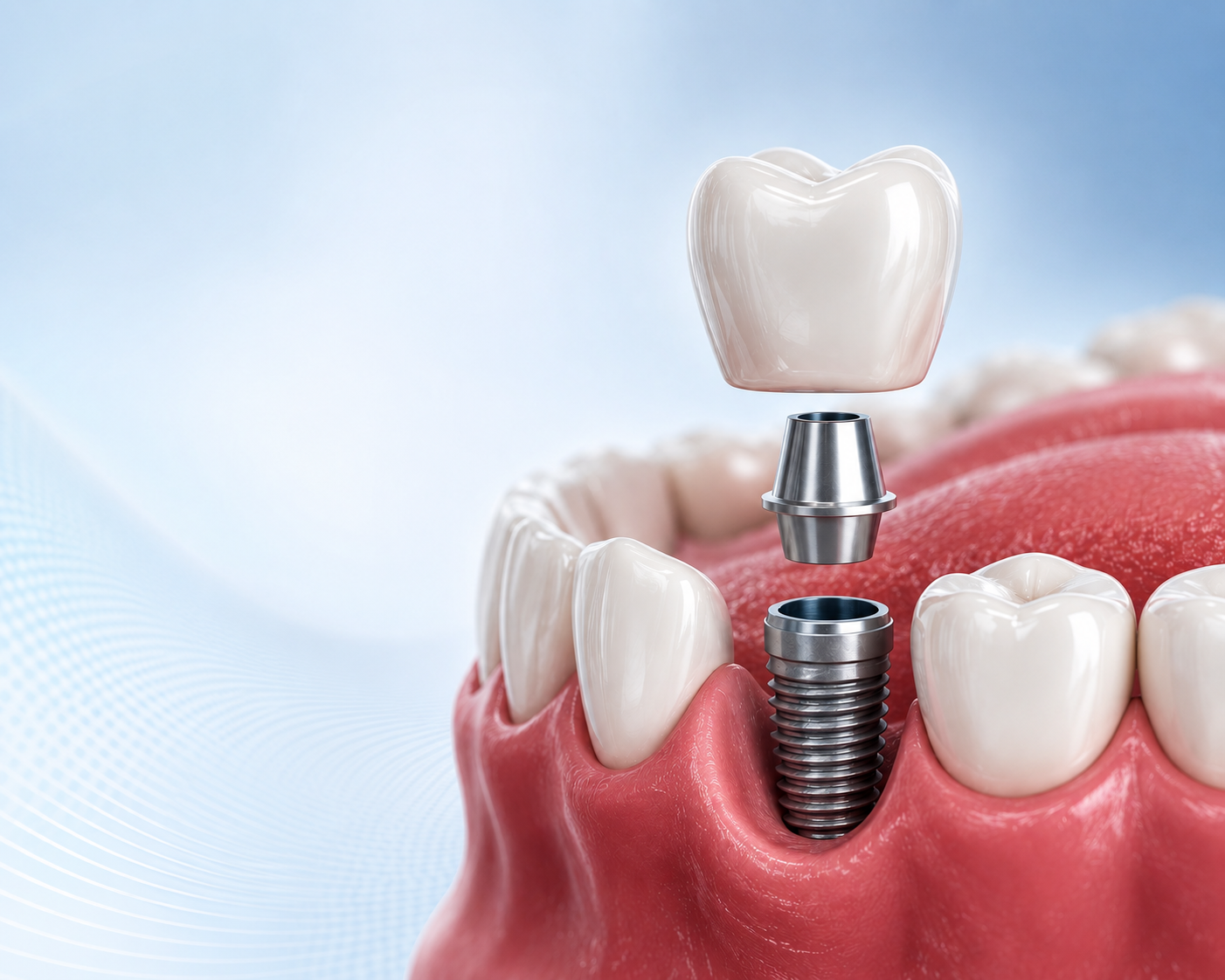 Popular dental treatments in Turkey